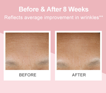Before-and-after photos demonstrating improvement in forehead wrinkles