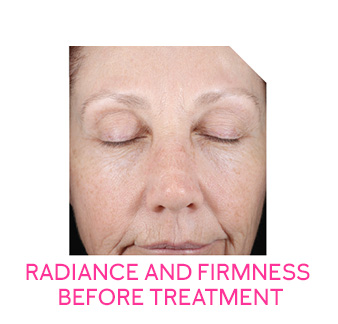 Image of face before the eight-week retinization process with Mary Kay Clinical Solutions® Retinol 0.5 Set